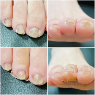 ネイル 深爪・巻き爪 専門サンセリテのネイルデザイン