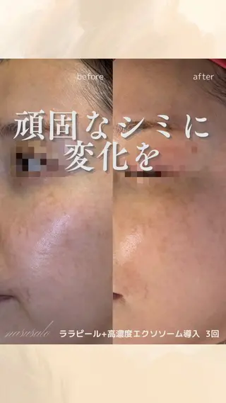 肌質改善フェイシャル 看護師 只野のエステ・リラクイメージ