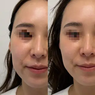肌質改善×毛穴洗浄 ナスサロ 看護師只野のエステ・リラクイメージ