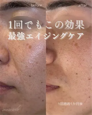 肌育×小顔×毛穴洗浄 ナスサロ 看護師只野のエステ・リラクイメージ