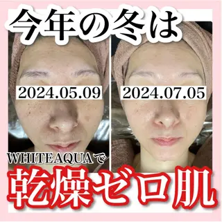毛穴・ニキビケア・ハーブピーリング 肌管理専門店 WHITE AQUA 神戸三宮店所属・🌷あいり 🌷のエステ・リラクイメージ