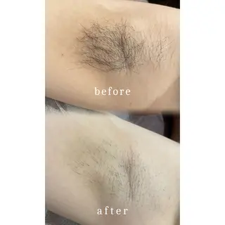 メルシー13所属・トータル美容サロン☆ 脱毛/小顔/毛穴洗浄のエステ・リラクイメージ