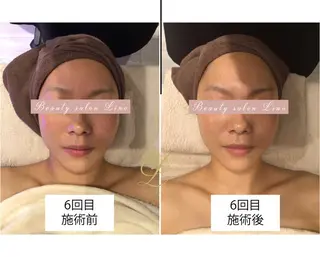 痩身×フェイシャル ブライダル|Linoのエステ・リラクイメージ