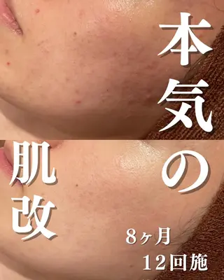 憧れの韓流すっぴん肌 🤎肌管理専門エステのエステ・リラクイメージ