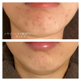 ニキビ跡専門サロン Ainaのエステ・リラクイメージ