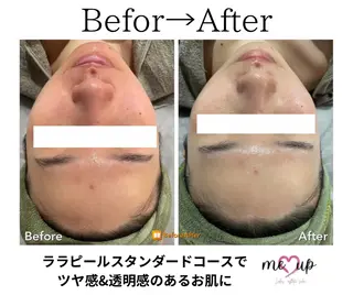 Meupニキビ専門店 背中/ハーブ/ララのその他イメージ