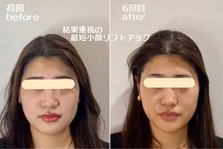 最速小顔・肌質管理 ❣️エスポワールのエステ・リラクイメージ