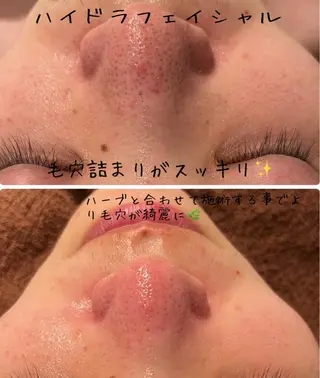 【ハーブピーリング/毛穴洗浄】NA skin 川崎店〜ニキビ・毛穴専門店〜所属・NAホワイトニング 川崎店のエステ・リラクイメージ