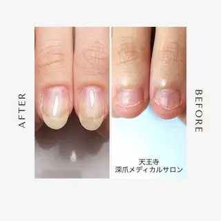 ネイル 天王寺 深爪メディカルサロンのネイルデザイン