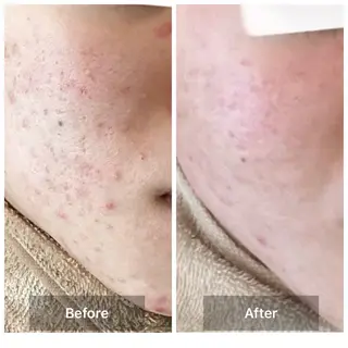 メンズ ハーブピーリング 専門店MOKA所属・ハーブピーリング専門 MOKAのエステ・リラクイメージ