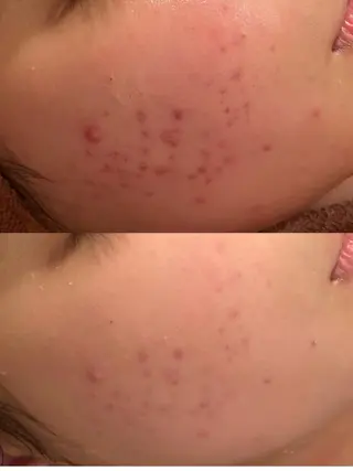 6万人の美肌実績🔥 最短ニキビ改善のエステ・リラクイメージ