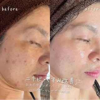 【ハーブピーリング/毛穴洗浄】NA skin 川崎店〜ニキビ・毛穴専門店〜所属・NAホワイトニング 川崎店のエステ・リラクイメージ