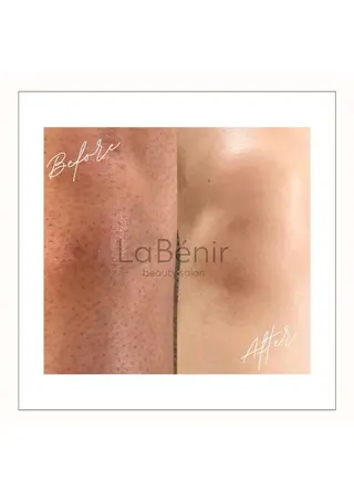 メンズ キッズ 脱毛/美肌【皮膚科看 護師経営】ラベニールのエステ・リラクイメージ