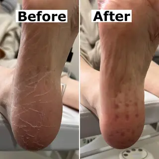 ネイル Mellow nail所属・巻爪無料モデル募集 ✨🦶MEGUMIのネイルデザイン