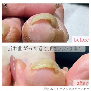 ネイル 深爪・巻き爪 専門サンセリテのネイルデザイン
