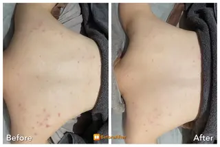 Meupニキビ専門店 背中/ハーブ/ララのその他イメージ