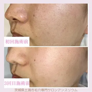 毛穴ケア専門サロンアンスリウム所属・茨城土浦 つくば毛穴 ケア専門サロンのエステ・リラクイメージ