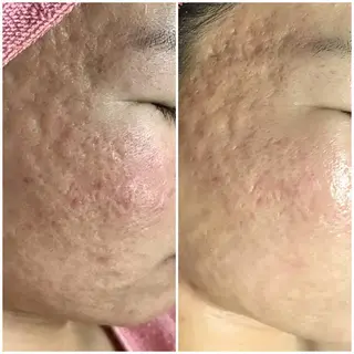 高速脱毛エステ リアンのエステ・リラクイメージ