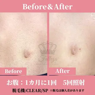 メンズ キッズ 有人型セルフサロン 脱毛/痩身/美顔のその他イメージ