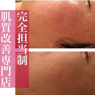 学生ニキビ改善🍀 優しい肌質改善のエステ・リラクイメージ