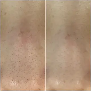 ニキビケアサロン|Motorihi【モトリヒ】所属・ニキビケア Moto rihi【モトリヒ】のエステ・リラクイメージ