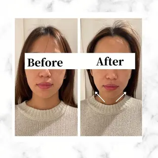 12Dハイフ💗 最強小顔のエステ・リラクイメージ