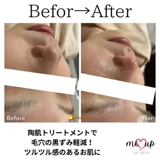 Meupニキビ専門店 背中/ハーブ/ララのその他イメージ