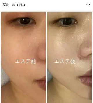 毛穴/ピーリング ララピール/POLAのエステ・リラクイメージ