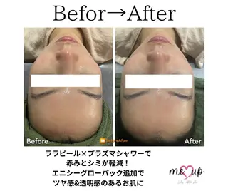 Meupニキビ専門店 背中/ハーブ/ララのその他イメージ