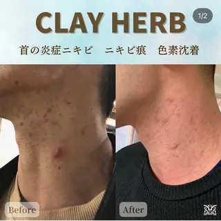 VIKI BEAUTY  クレイハーブピーリング・美肌脱毛専門店所属・VIKI BEAUTYのエステ・リラクイメージ