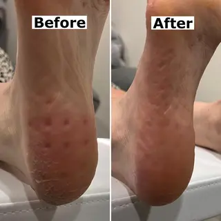 ネイル Mellow nail所属・巻爪無料モデル募集 ✨🦶MEGUMIのネイルデザイン