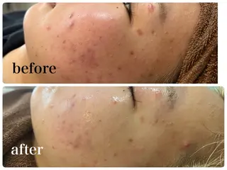 Total beauty salon Dune所属・ニキビ・肌質改善 サロンDuneのエステ・リラクイメージ