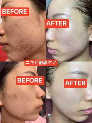 ニキビ、痩身、脱毛、 サクラチャンスパのエステ・リラクイメージ