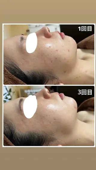 心斎橋痩身ダイエット 韓国.美容鍼.小顔のエステ・リラクイメージ