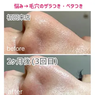 毛穴洗浄/ニキビ 肌質改善サロンのエステ・リラクイメージ