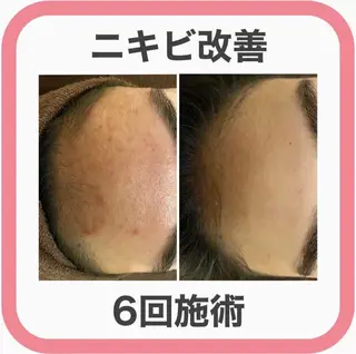 学生ニキビ改善🍀 優しい肌質改善のエステ・リラクイメージ