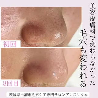 毛穴ケア専門サロンアンスリウム所属・茨城土浦 つくば毛穴 ケア専門サロンのエステ・リラクイメージ