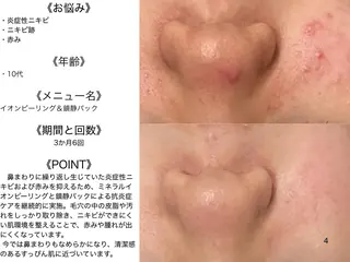 🔥3か月で肌革命 🔥ニキビ専門店のエステ・リラクイメージ