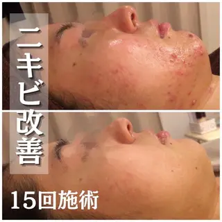 皮膚科より効果あり ⁉️最短ニキビ改善のエステ・リラクイメージ