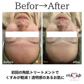 Meupニキビ専門店 背中/ハーブ/ララのその他イメージ