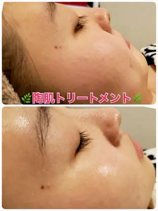 【リベルハーブピーリング認定店】敏感肌・美白脱毛専門店Dione立川店所属・Dione 立川店のエステ・リラクイメージ