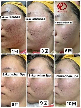 ニキビ、痩身、脱毛、 サクラチャンスパのエステ・リラクイメージ