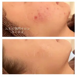 ミディアム パーマ ヘアアレンジ メンズ キッズ ネイル マツエク・マツパ アイブロウ ニキビ跡専門サロン Ainaのエステ・リラクイメージ