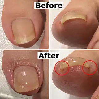 ネイル Mellow nail所属・巻爪無料モデル募集 ✨🦶MEGUMIのネイルデザイン