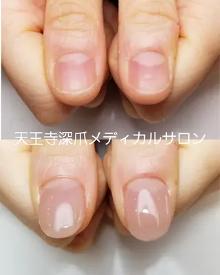 ネイル 天王寺 深爪メディカルサロンのネイルデザイン