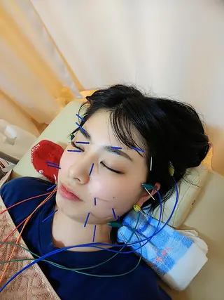 リフトアップ・たるみ ☆美容鍼小顔矯正のその他イメージ