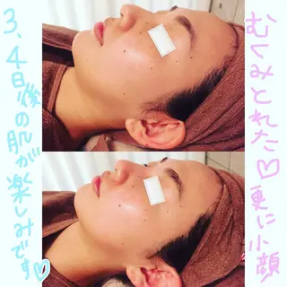 【ニキビ/肌管理】 salon varyのエステ・リラクイメージ