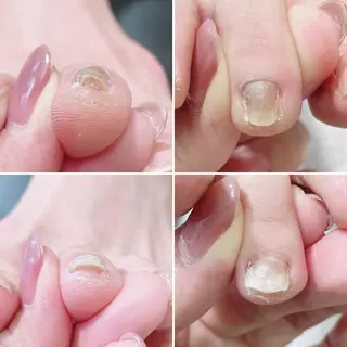 ネイル 深爪・巻き爪 専門サンセリテのネイルデザイン