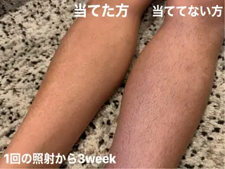 メンズ 脱毛＆エステサロン【アンリミット】所属・森谷 莉美のエステ・リラクイメージ