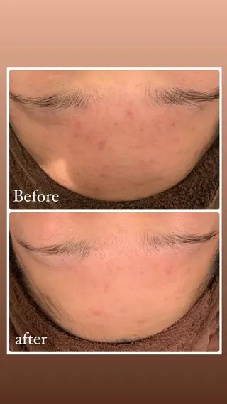 肌質改善ハーブピー リング🌿RINAのエステ・リラクイメージ